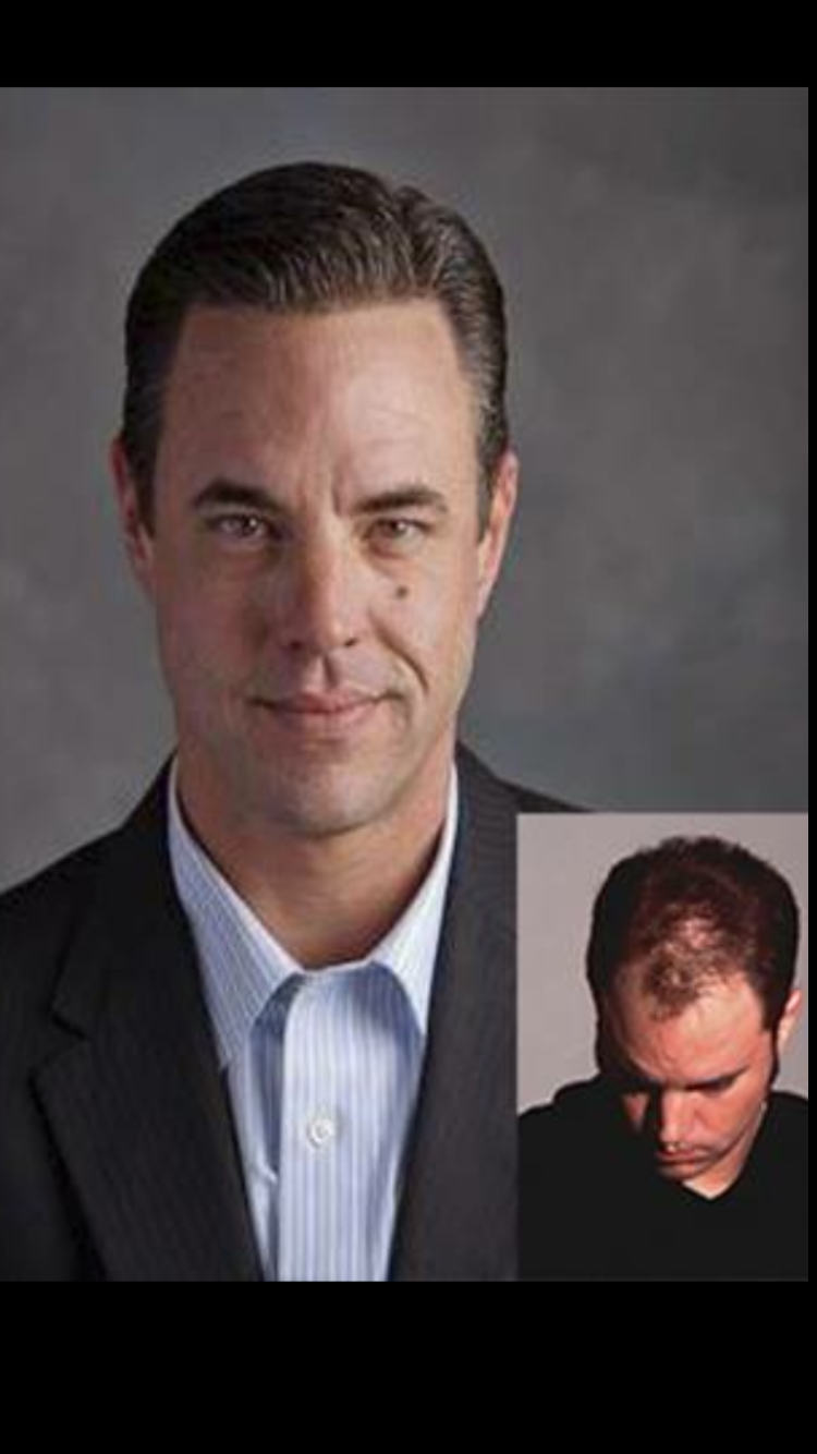 Alan Humphreys before and after hair restoration